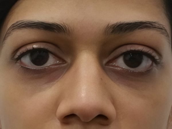 Under eye dermal filler 1 (after)