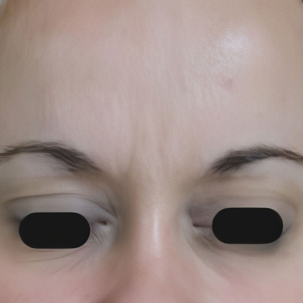 Anti-Wrinkle Treatment 10 (after)
