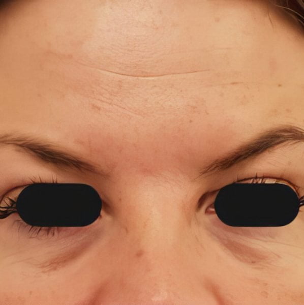 Anti-Wrinkle Treatment 9 (after)