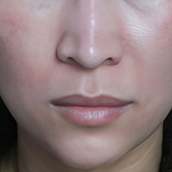 Chemical Peel 15 (after)