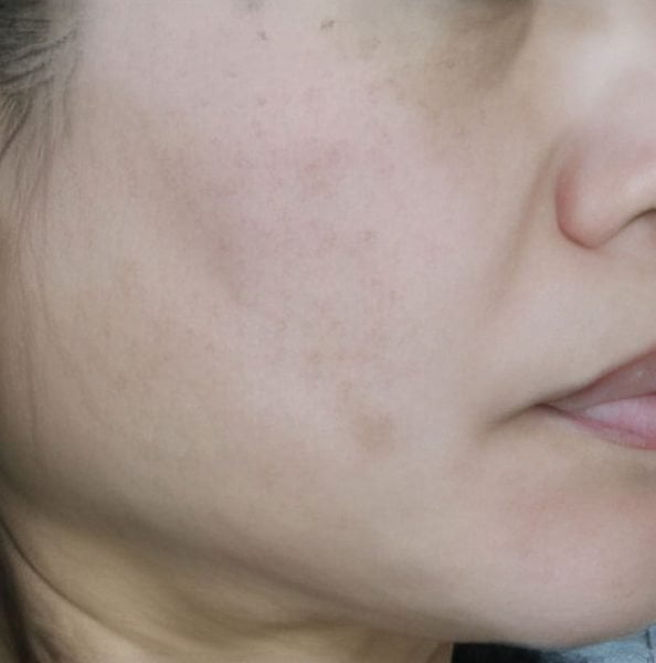 Chemical Peel 34 (after)
