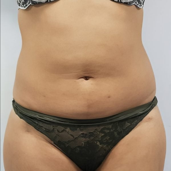 Tummy Liposuction 5 (before)