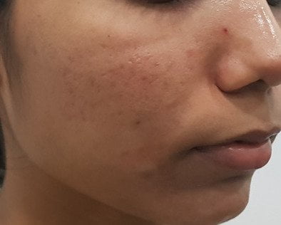 Acne Scar Treatment 4 (after)