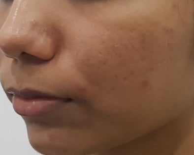 Acne Scar Treatment 5 (after)