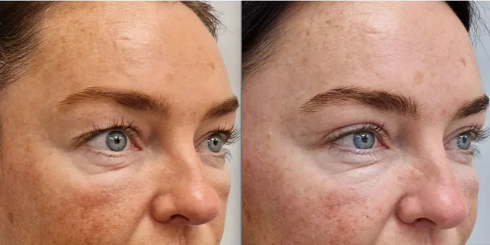 UPLOAD upper blepharoplasty 2 2 1