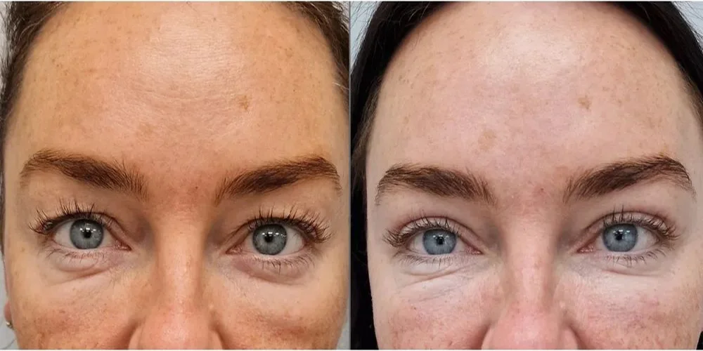 UPLOAD upper blepharoplasty 2 3 1