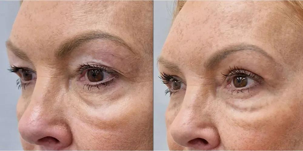 UPLOAD upper blepharoplasty 3 1 1