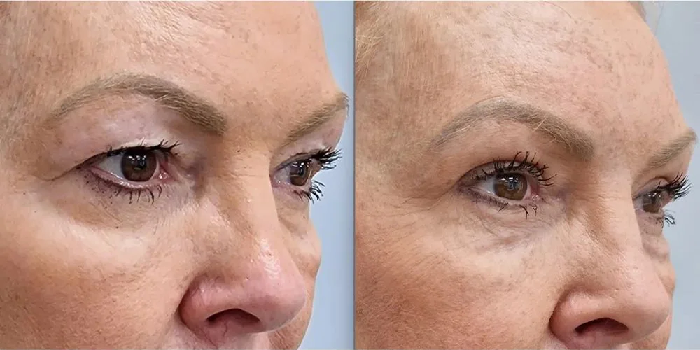 UPLOAD upper blepharoplasty 3 3 1