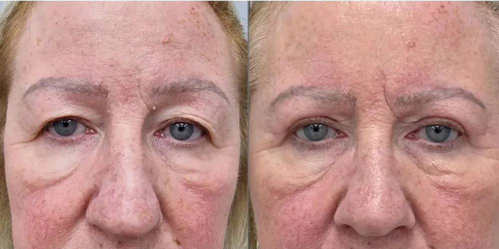 UPLOAD upper blepharoplasty 4 3 1