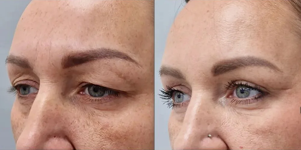 upper blepharoplasty 10 1