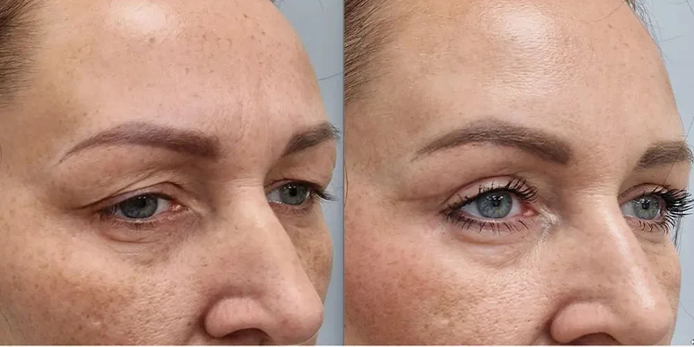 upper blepharoplasty 101 1
