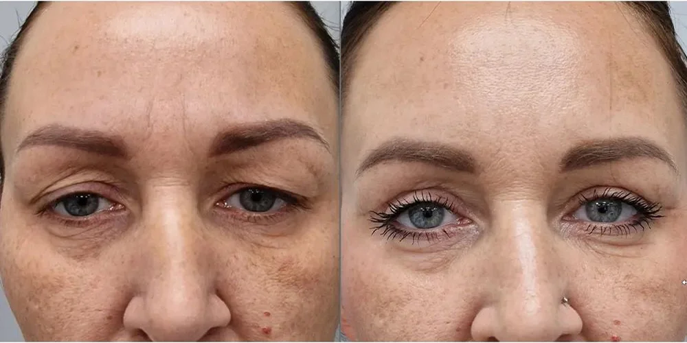 upper blepharoplasty 102 1