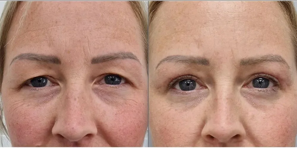 upper blepharoplasty 11 1