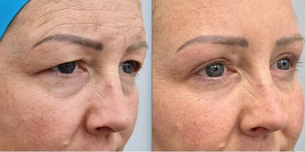 upper blepharoplasty 111 1