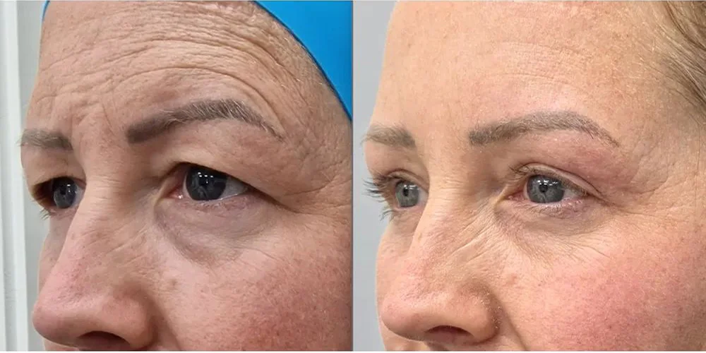 upper blepharoplasty 112 1