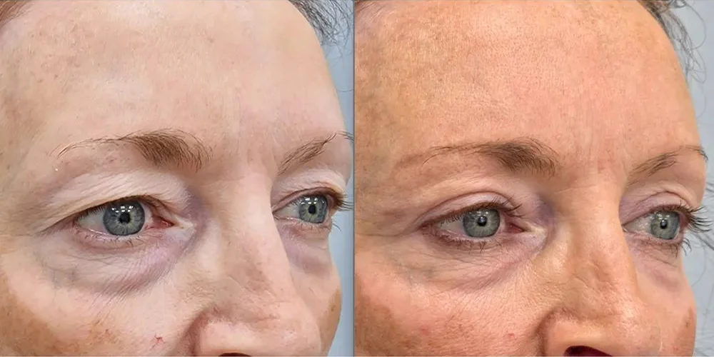 upper blepharoplasty 121 1