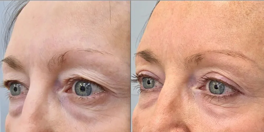 upper blepharoplasty 122 1