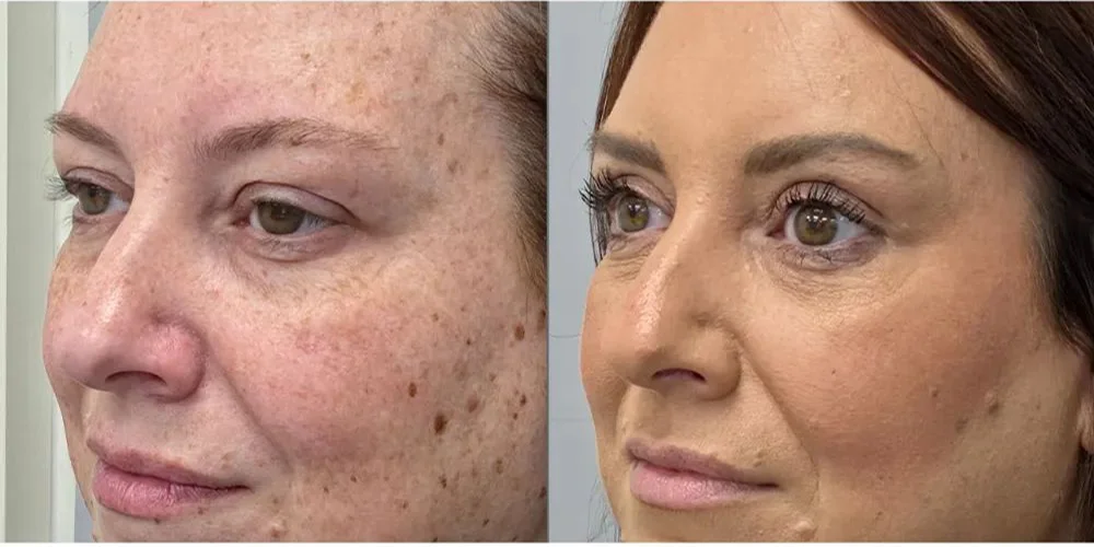 upper blepharoplasty 13 1