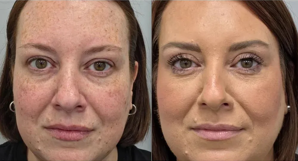 upper blepharoplasty 132 1