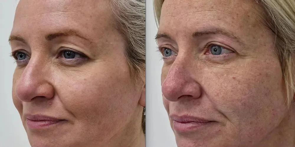 upper blepharoplasty 15 1