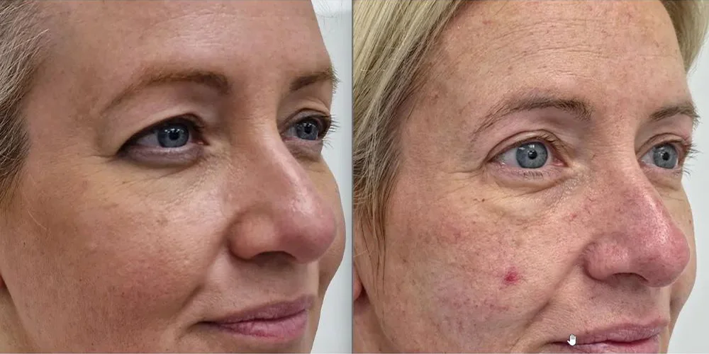 upper blepharoplasty 151 1