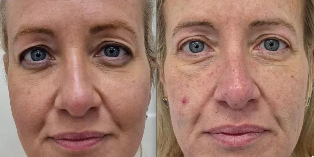 upper blepharoplasty 152 1