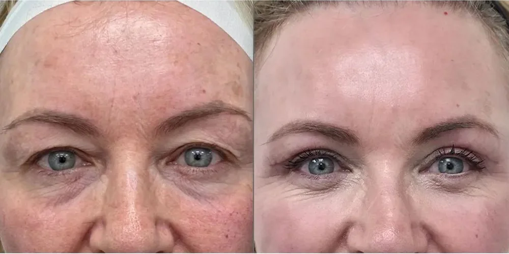 upper blepharoplasty 5 1