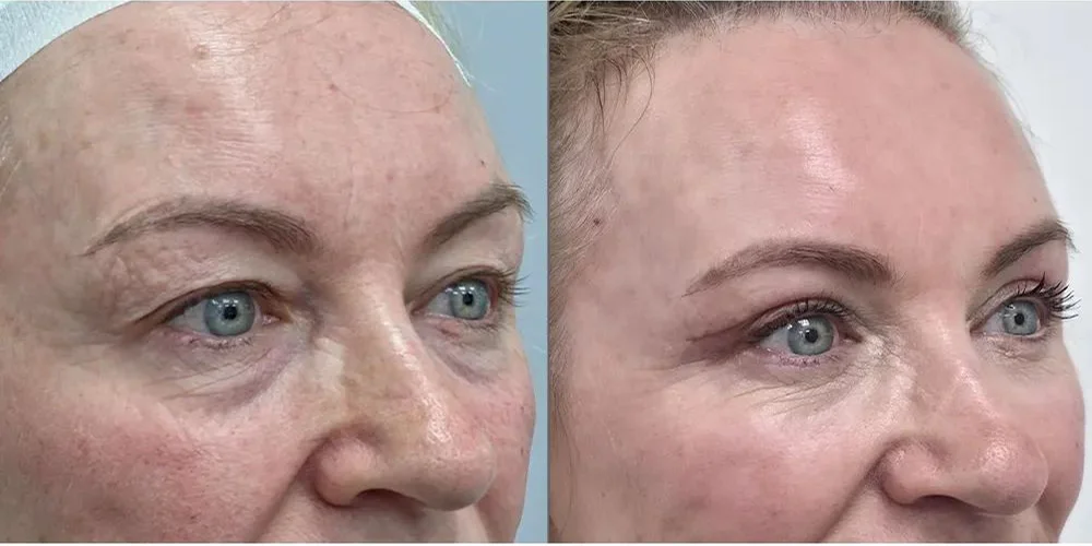upper blepharoplasty 52 1