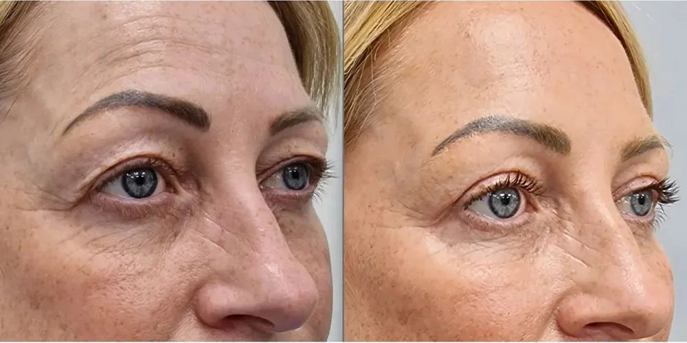 upper blepharoplasty 7 1