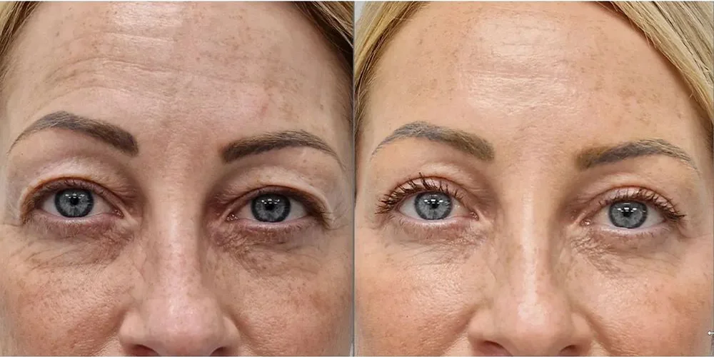 upper blepharoplasty 71 1
