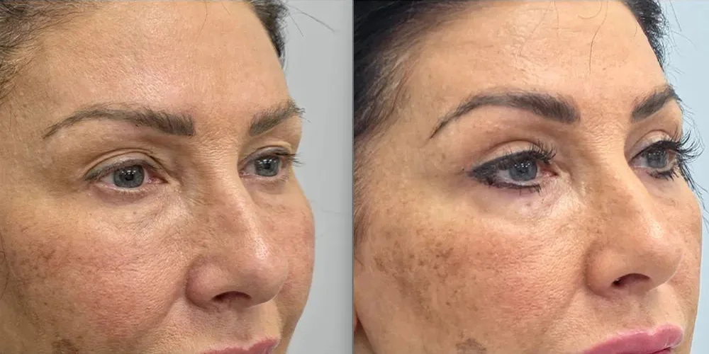 upper blepharoplasty 9 1