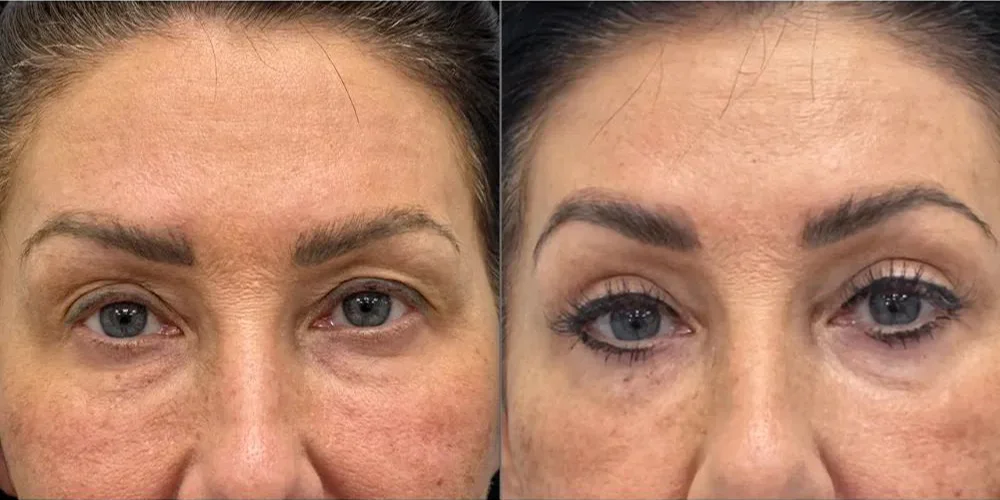 upper blepharoplasty 91 1