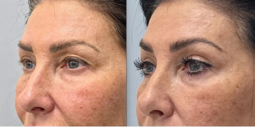 upper blepharoplasty 92 1