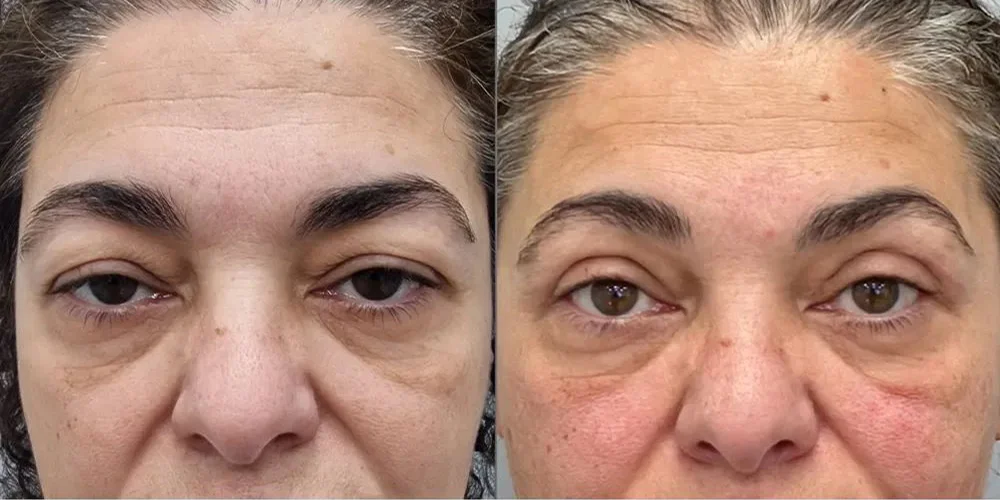 upper blepharoplasty pt 1 1 1