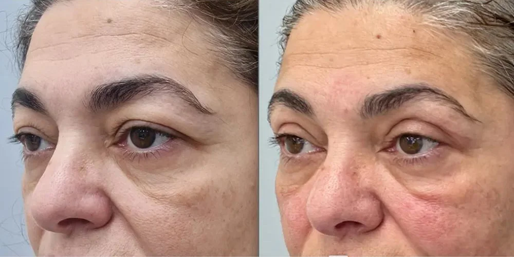 upper blepharoplasty pt 1 2 1