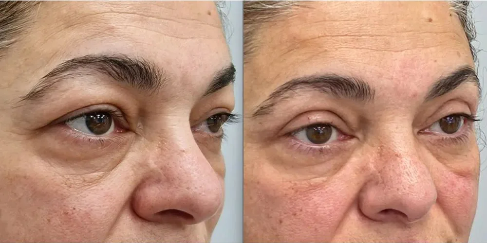 upper blepharoplasty pt 1 3 1